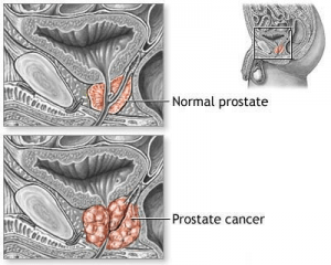 pterostilbene prostate
